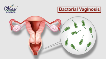 क्या होता है बैक्टीरियल वेजिनोसिस? जानें इसके कारण और लक्षण