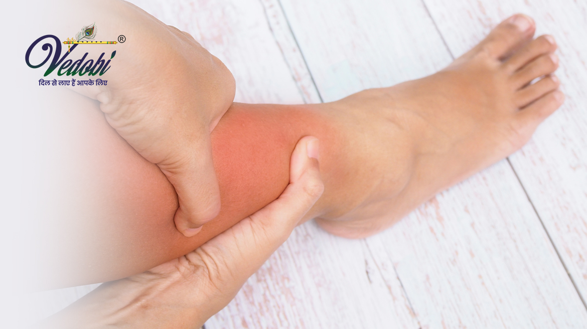 Know the Symptoms, Causes, Diagnosis and Treatment of Edema