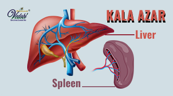 काला अज़ार क्या है? जानें, इसके लक्षण, कारण और बचाव