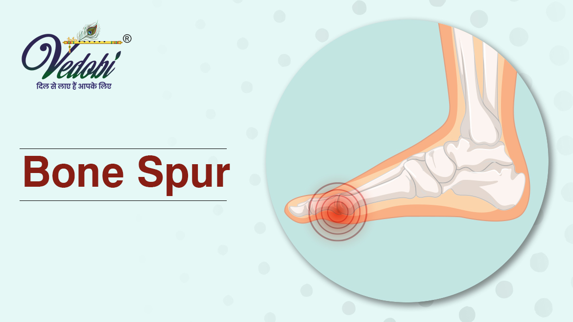 Bone spur- Causes, Symptoms & Treatment methods