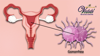 क्या होता है गोनोरिया? जानें इसके लक्षण कारण और उपचार