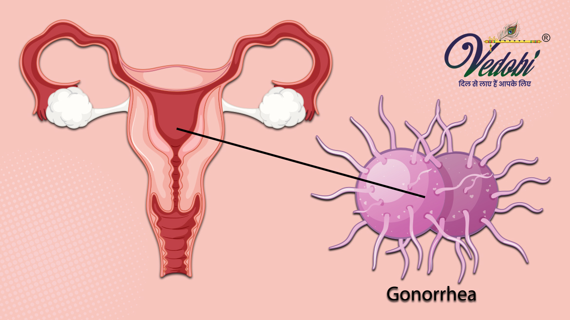 क्या होता है गोनोरिया? जानें इसके लक्षण कारण और उपचार
