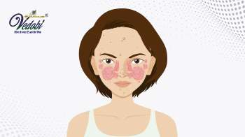 लुपस क्या है? जानें इसके कारण, लक्षण और प्राकृतिक उपचार