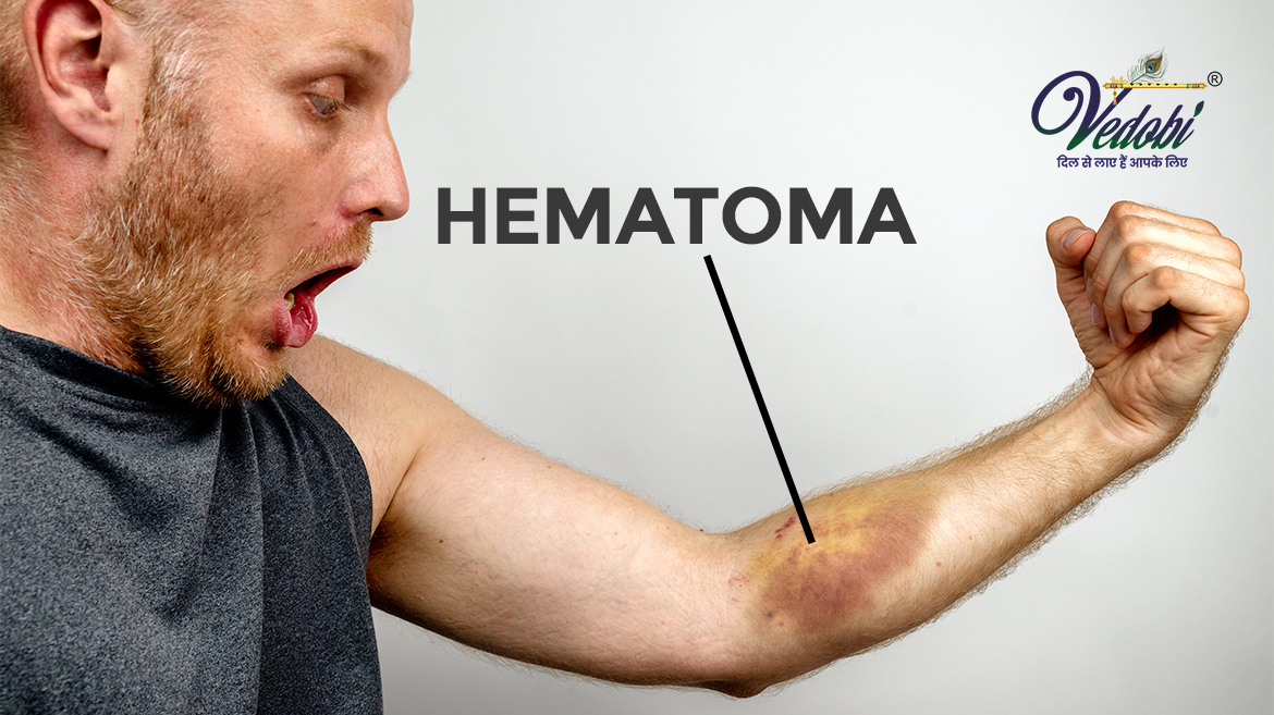 All You Need to Know about Hematoma