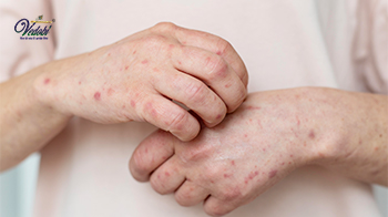 What is Syphilis? Know its causes, treatments, and home remedies