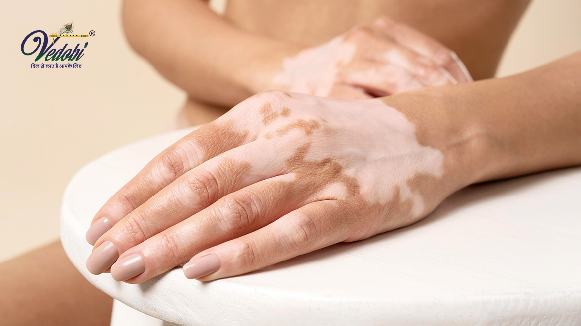 Ayurvedic treatment for Shwitra